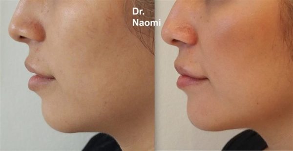 Before and after treatments including chin