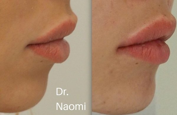 Before and after treatments including chin