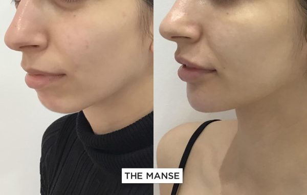 Before and after treatments including chin
