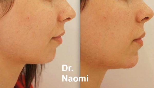 Before and after treatments including chin