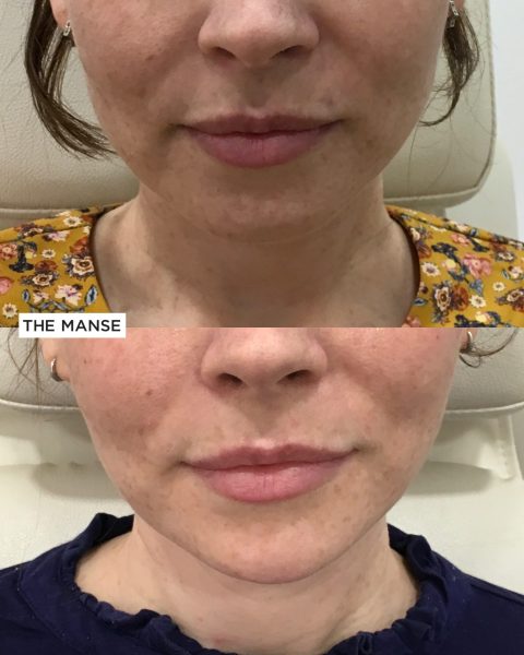 Before and after treatments including chin