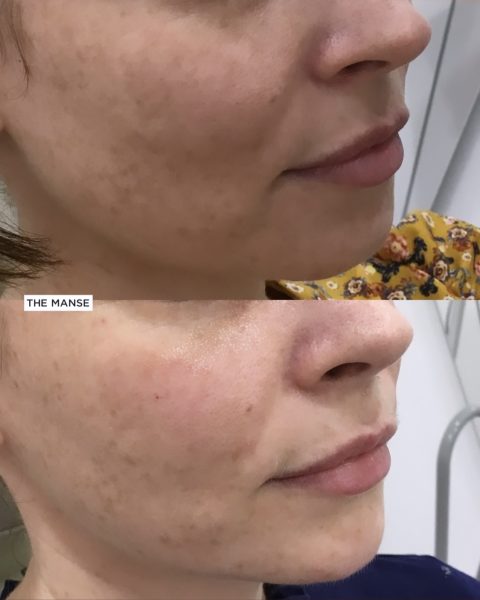 Before and after treatments including chin