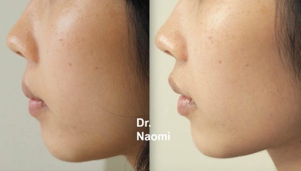 Before and after treatments including chin