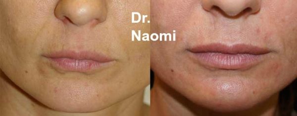 Before and after treatments including chin