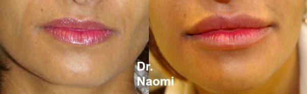 Before and after treatments including chin