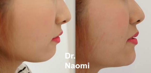 Before and after treatments including chin