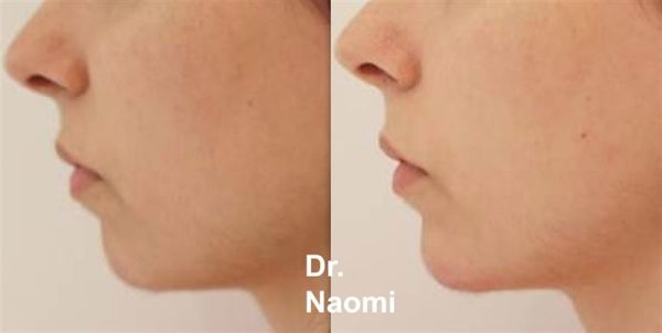 Before and after treatments including chin