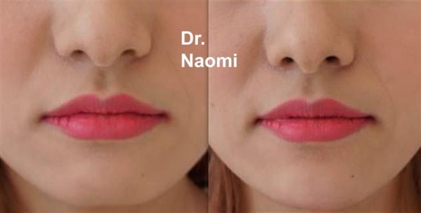 Before and after treatments including chin