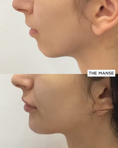 Before and after treatments including chin