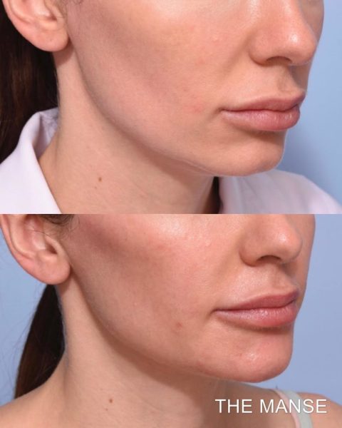Before and after treatments including chin