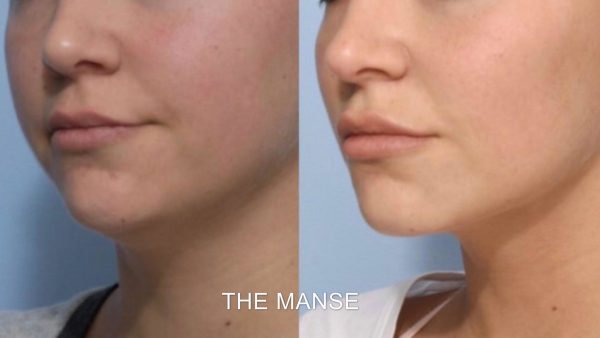 Before and after treatments including chin