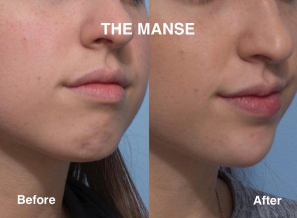 Before and after treatments including chin