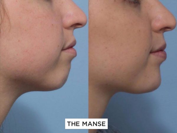 Before and after treatments including chin