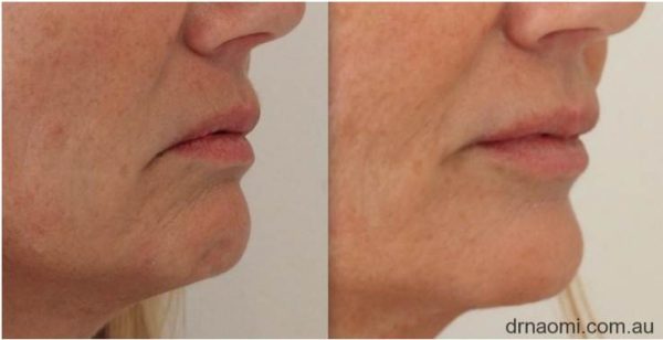 Before and after treatments including chin for sagging jowls and downturned mouth