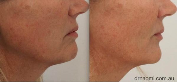 Before and after treatments including chin treatments