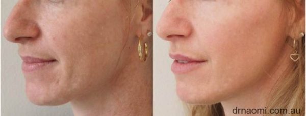 Before and after treatments to face