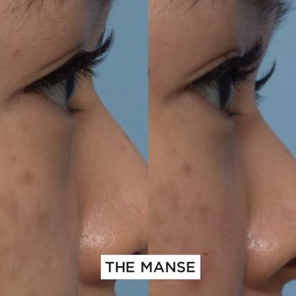 Before and after under eye treatment
