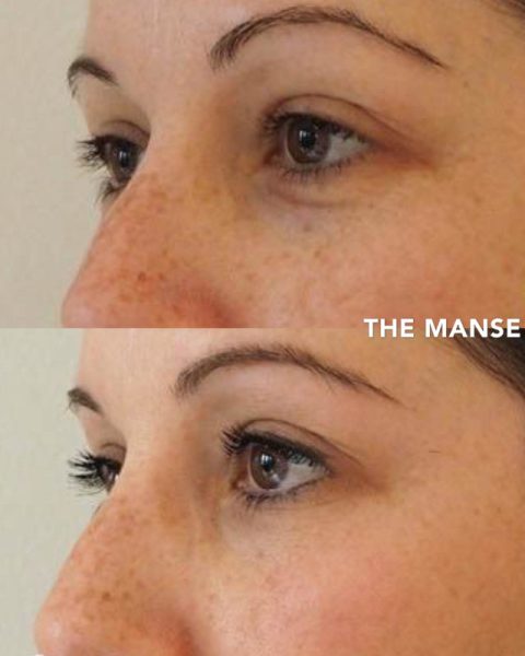 Before and after under eye treatments