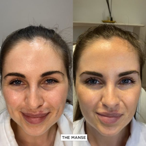 Crows feet treatment before and after