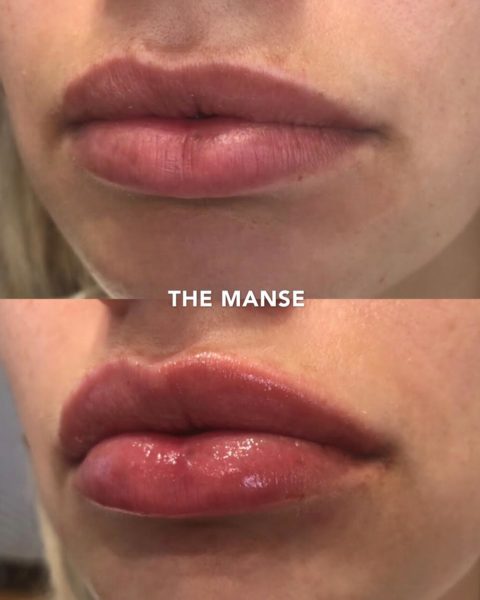 Cupids bow improvement