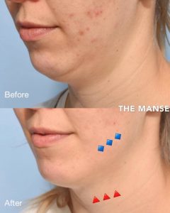 Double Chin treatments Note the jawline emerging at blue and the fat reduction at red arrows.
