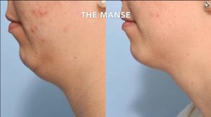 Double chin treatments