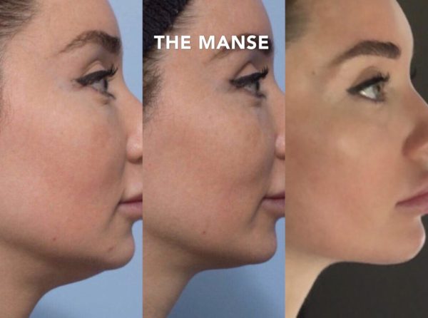 Double chin treatments before and after