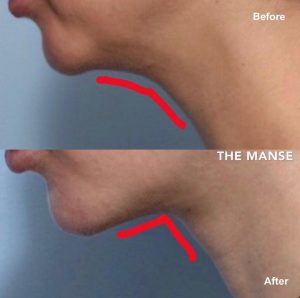 Double chin treatments change the neck angle
