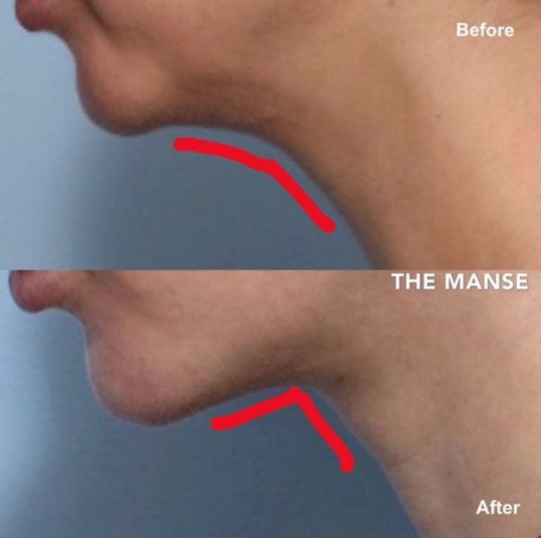 Double chin treatments to change the neck angle