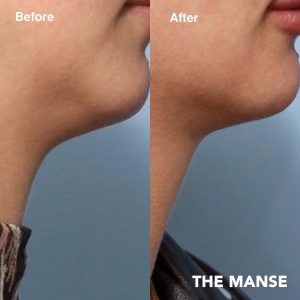 Double chin treatments