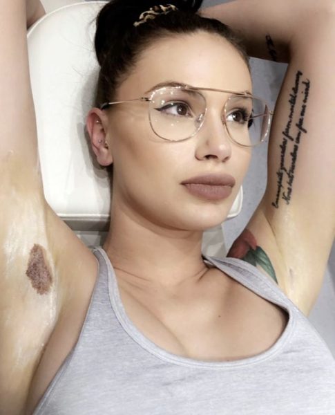 Excessive underarm sweating