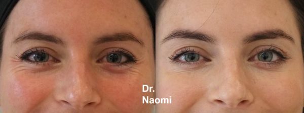 Eye wrinkle treatment