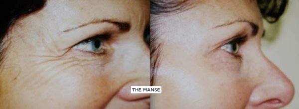 Eye wrinkles softened