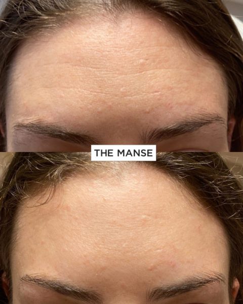 Forehead treatment before and after