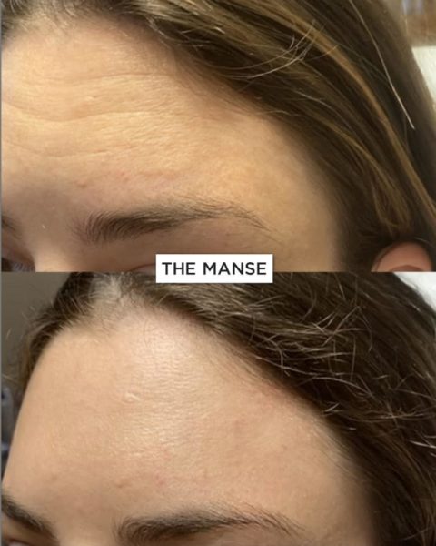 Forehead wrinkle treatments