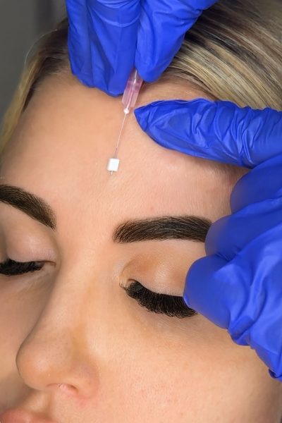 Frown line treatments