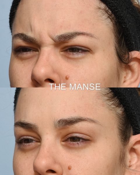 Frown line treatments before and after