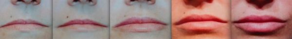 Gradually growing thin lips with treatment