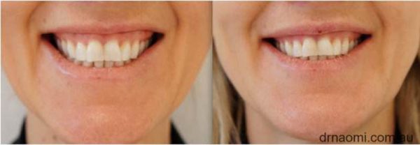 Gummy Smile Treatment