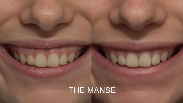 Gummy smile before and after