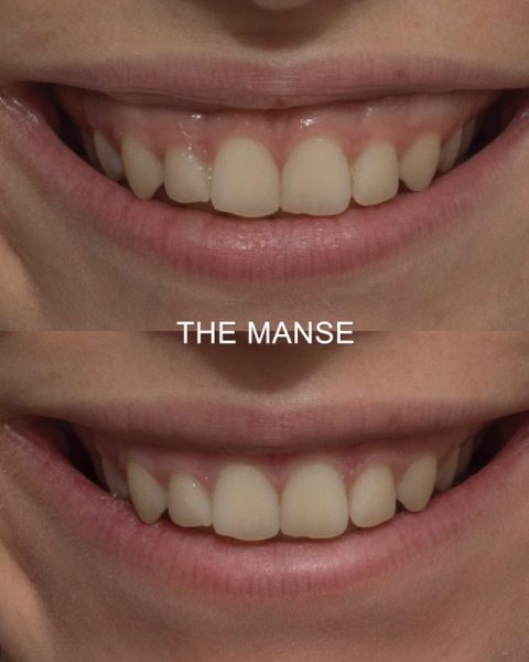Gummy smile treatment before and after