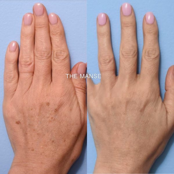 Hand rejuvenation after 1 treatment