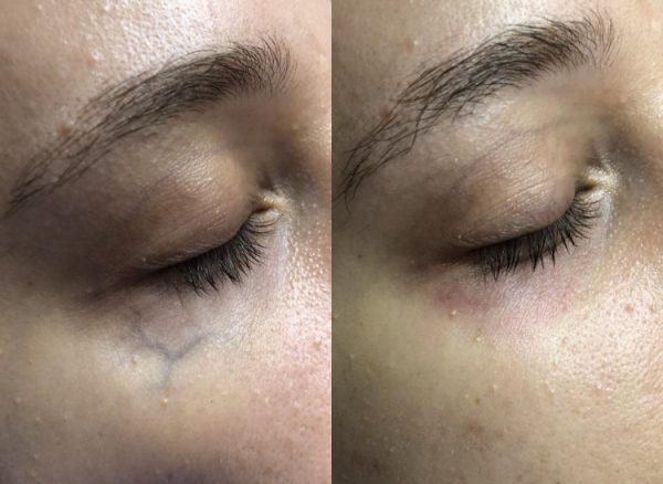 Before and after blue vein removal