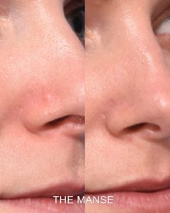 Colourless mole removal face