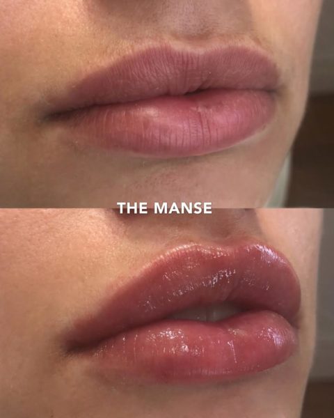 Improving cupids bow