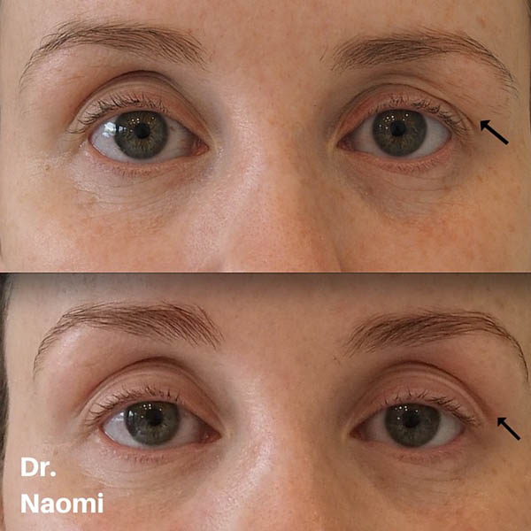 Improving eyelid sag 