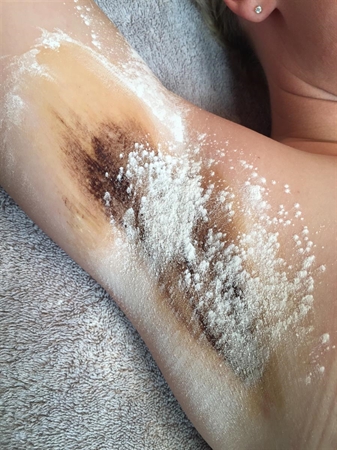 Iodine starch test for excessive sweating underarms