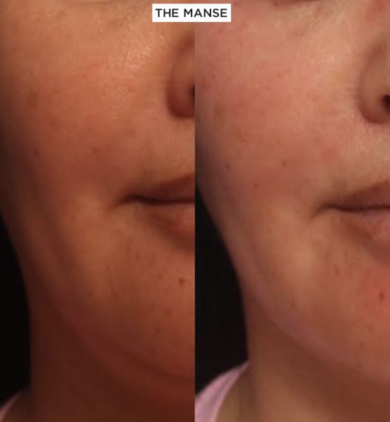 Jaw treatment
