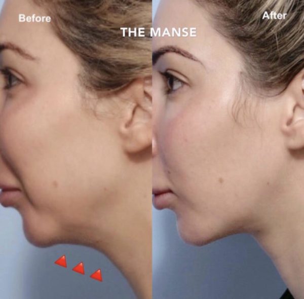 Jawline fat dissolving treatments before and after