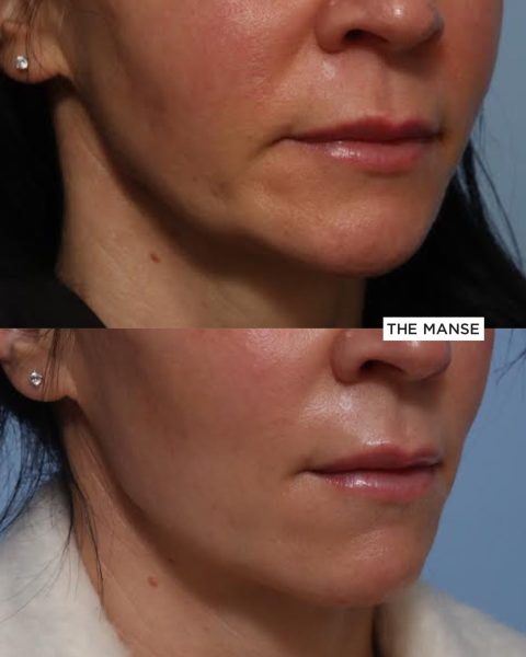 Jawline filler before and after. Also marionettes and nasolabial folds